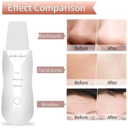 Ultrasonic Skin Scraper for Deep Cleansing